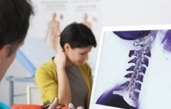 Tratamiento de la osteocondrosis cervical