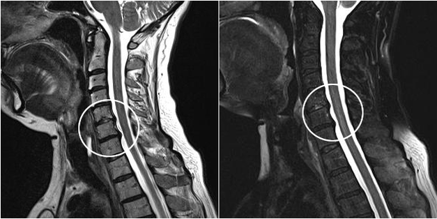 osteocondrosis cervical en imagen de resonancia magnética